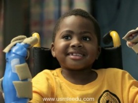全球首宗儿童双手移植手术宣告成功